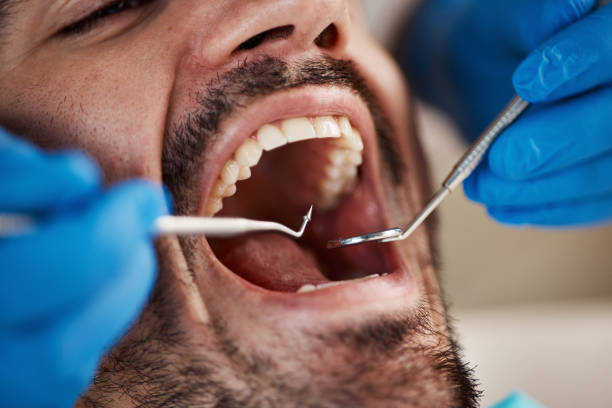 Best Chipped Tooth Repair Near Me  in North Grosvenor Dale, CT